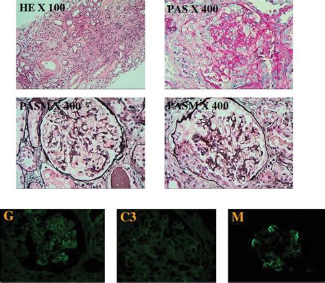 Treatment of membranous nephropathy with crescent nephritis by .
